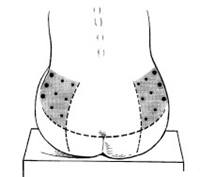 using the hips as an injection site