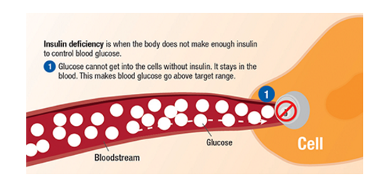 depiction of type one diabetes where there is no insulin key to allow glucose into the cell