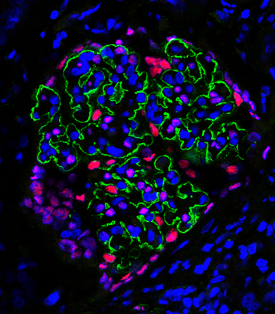 Fluorescent microscopy image of a kidney glomerulus showing cellular structures in multiple colors. Blue indicates cell nuclei, green outlines glomerular capillary loops, and red highlights podocyte markers. The image displays a dense cluster of cells with intricate green network patterns surrounded by blue-stained nuclei.