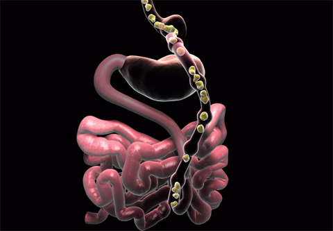 Gastric Bypass Surgery