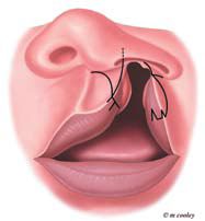 Cleft Lip Surgery