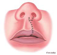 Cleft Lip Surgery