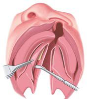 Cleft Palate Surgery