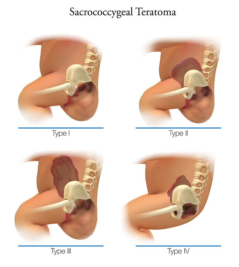 Types of Sacrococcygeal Teratoma