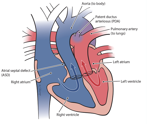 Illustration of congenital heart defect, transposition of the great arteries