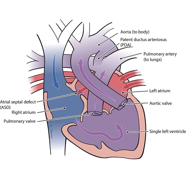 Illustration of the heart with a double-inlet left ventricle defect