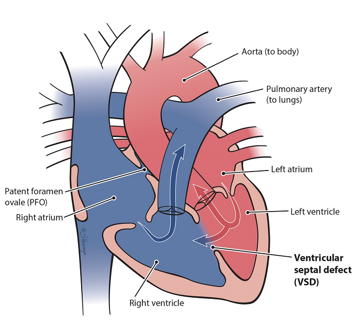 Heart illustration of a ventricular septal defect
