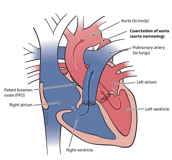 Heart illustration of coarctation of aorta