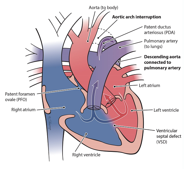 Heart illustration with its aortic arch interrupted