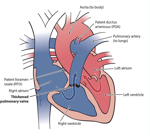 Heart with a thickened pulmonary valve