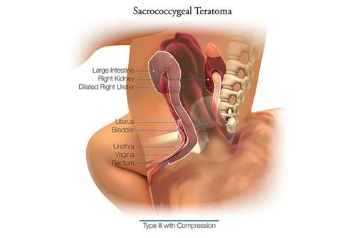 Sacrococcygeal Teratoma Type3