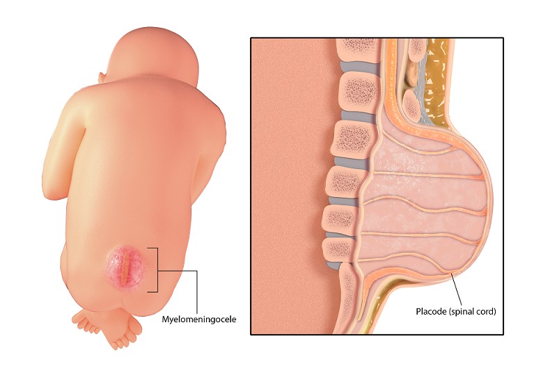 Illustration of a baby with spina bifida