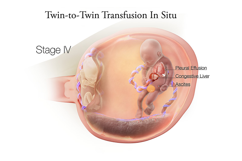Twin to Twin Transfusion Syndrome Stage 4