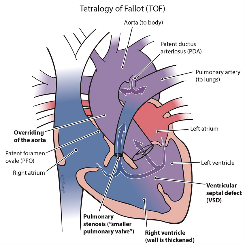 Tetralogy of Fallot