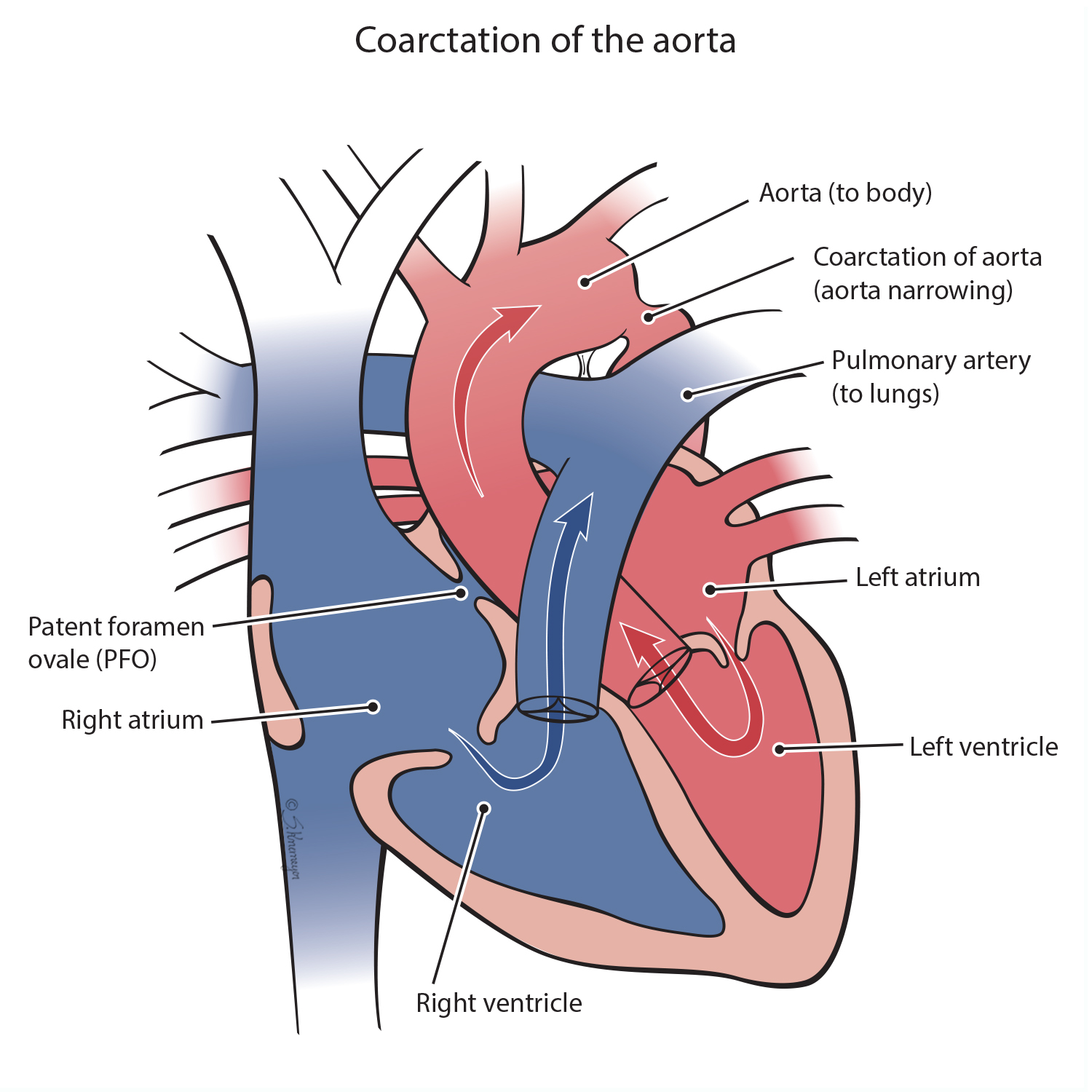Coarctation of the Aorta