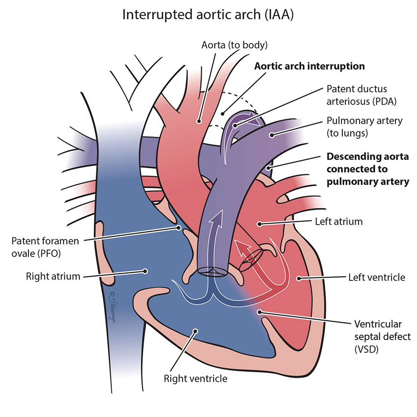Interrupted Aortic Arch