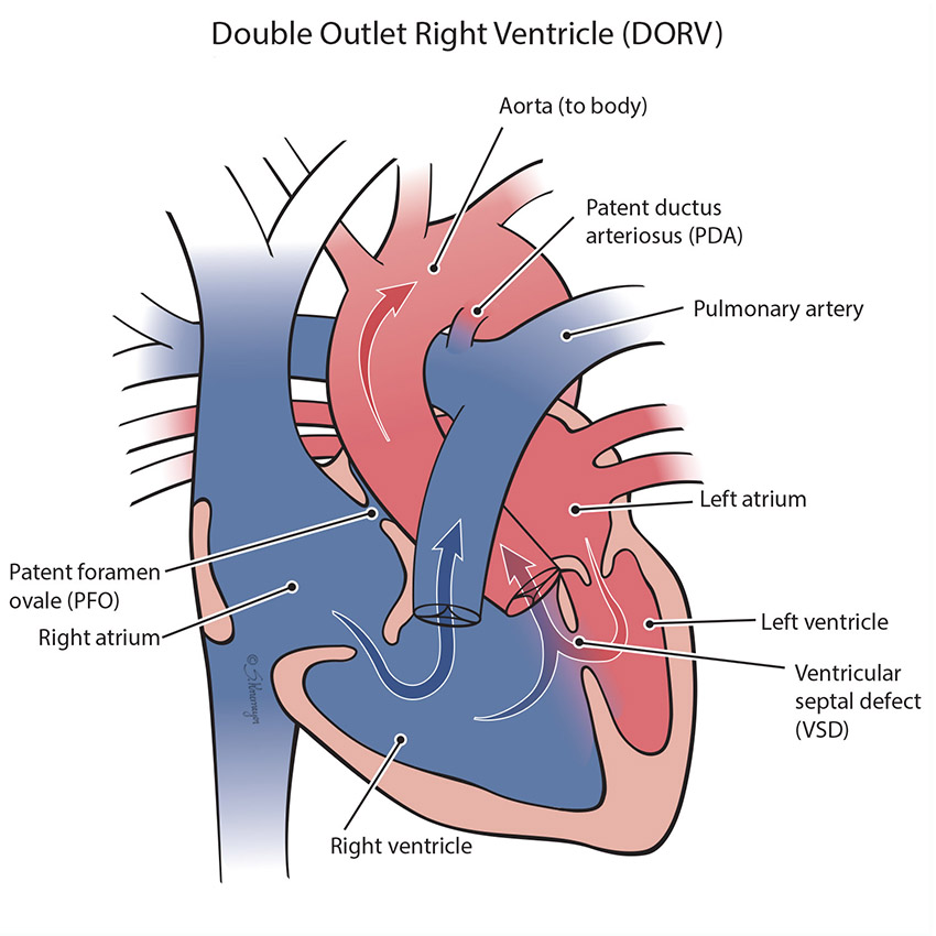 Double Outlet Right Ventricle