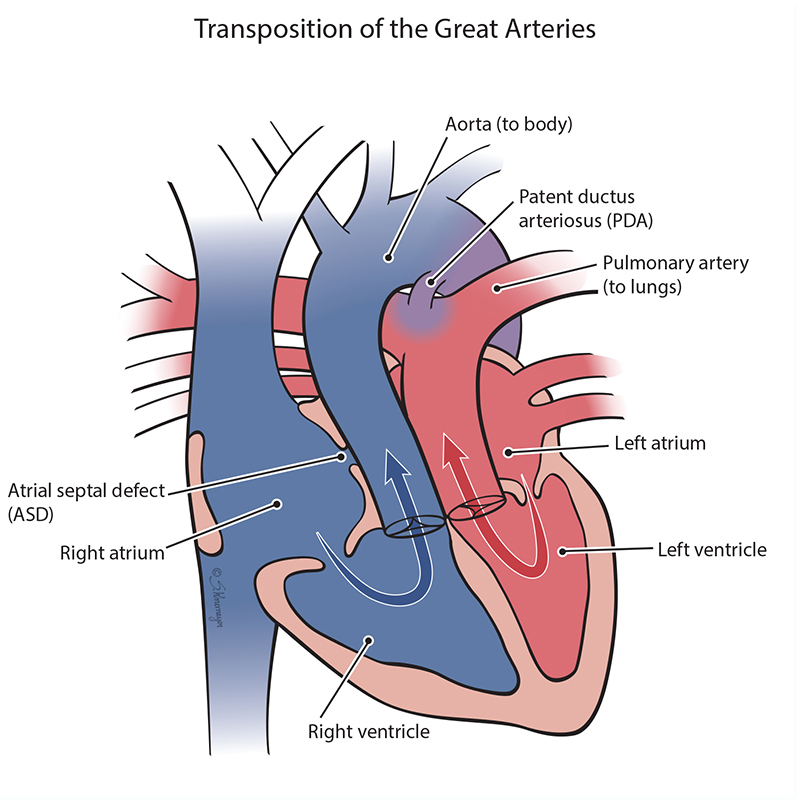 Transposition of the Great Arteries