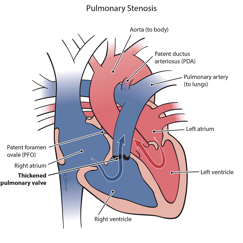 Pulmonary Stenosis