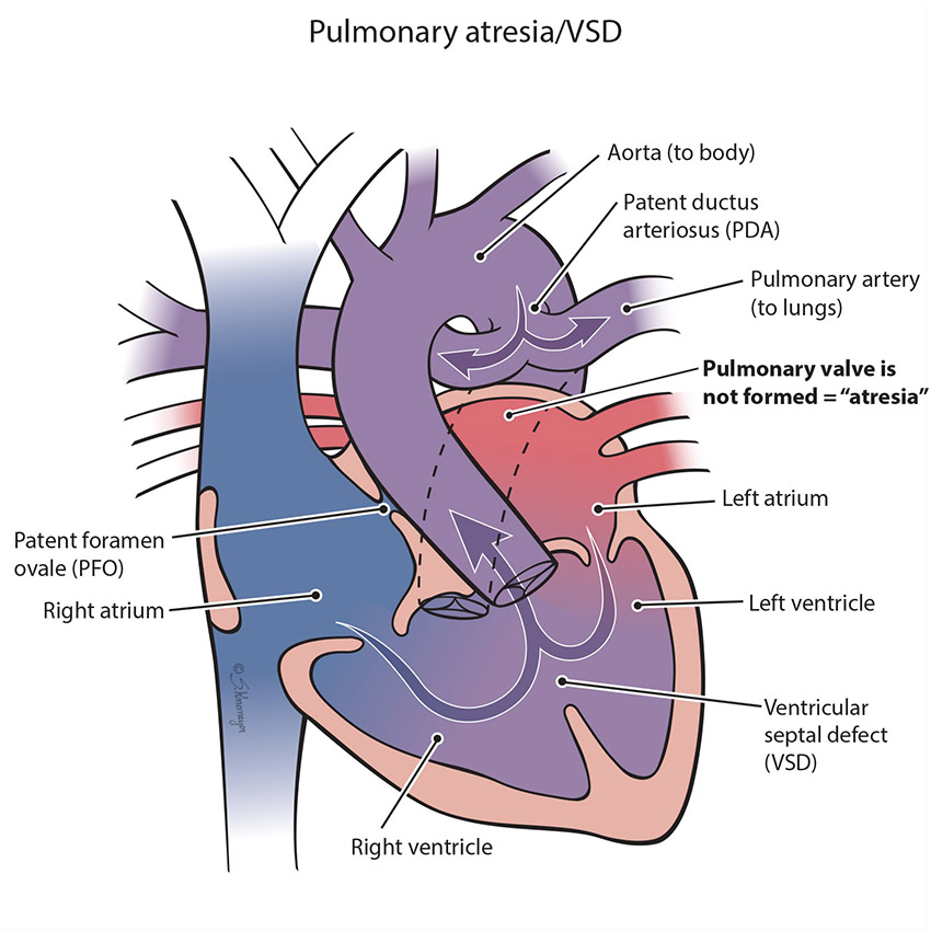 Pulmonary Atresia