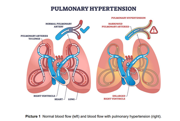 Illustration of Pulmonary Hypertension