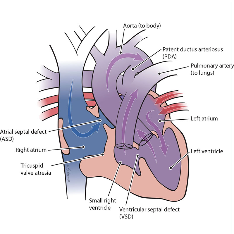 Tricuspid Atresia
