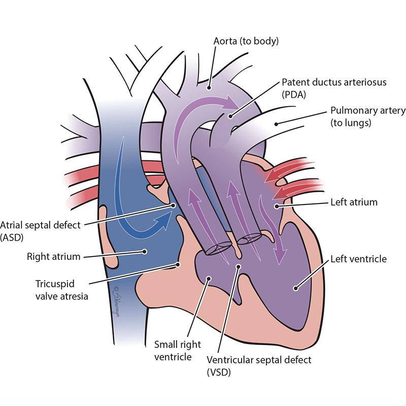 Tricuspid Atresia with Transposition of the Great Arteries