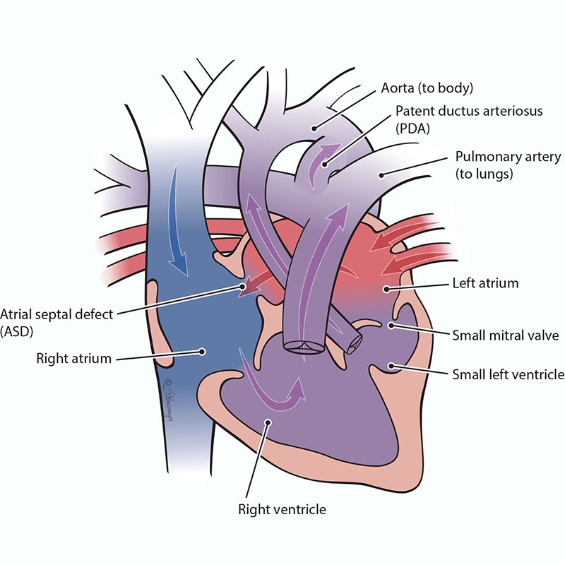 Double Outlet Right Ventricle and Hypoplastic Left Ventricle