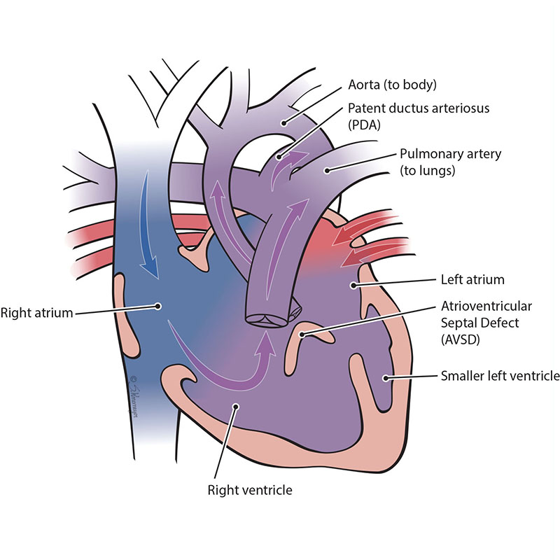 Right-dominant Unbalanced Atrioventricular Septal Defect