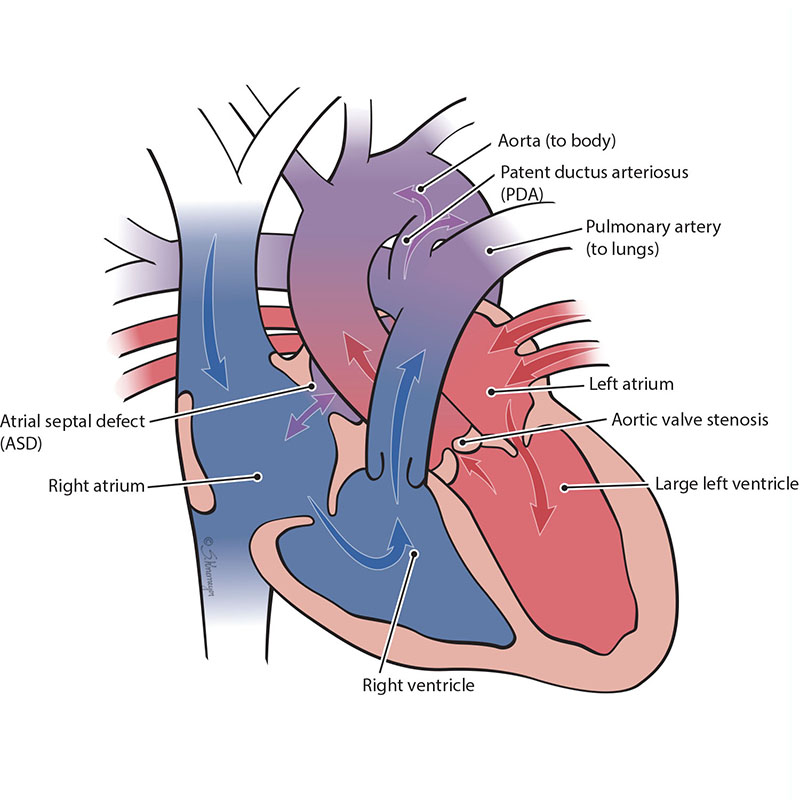 Aortic Valve Stenosis