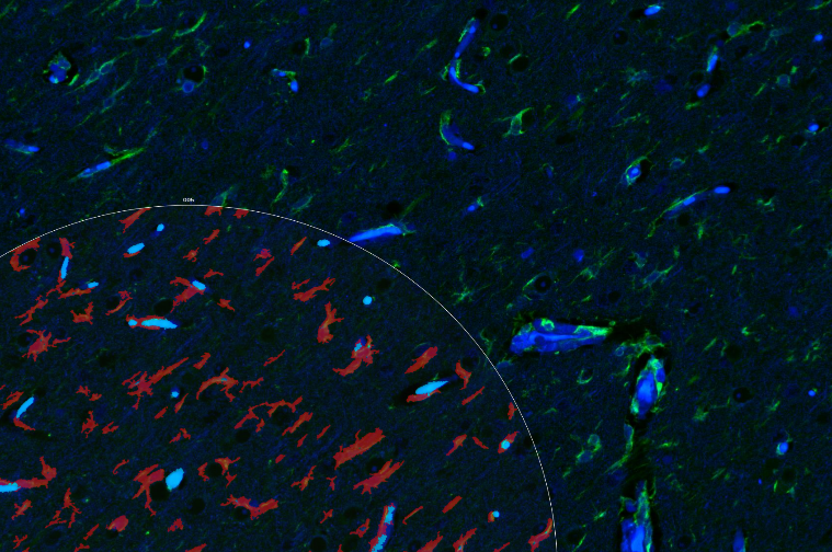 Epilepsy-Associated Brain Tumors