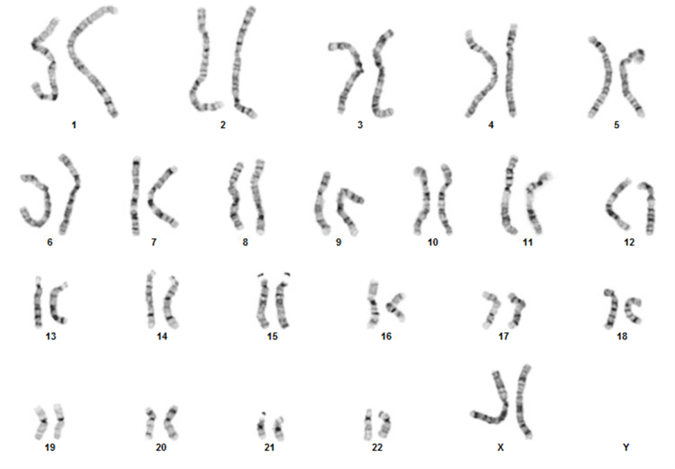 Karyogram of a newborn with a balanced translocation between the long arm of chromosome 3 and the long arm of chromosome 12