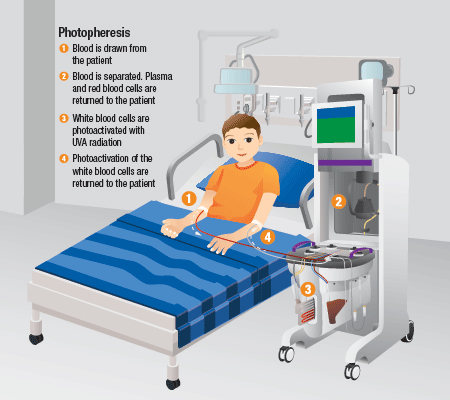 Photopheresis Clinic Treatment