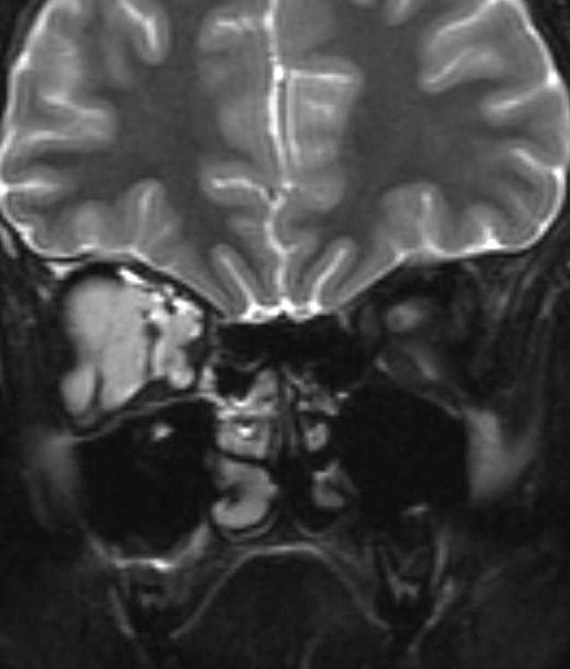 Jim Murakami, MD, ISSVA Presentation