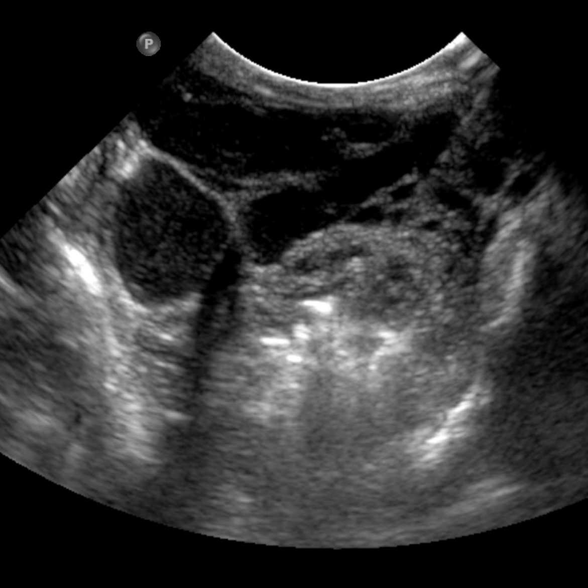 Jim Murakami, MD, ISSVA Presentation