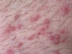 Folliculitis