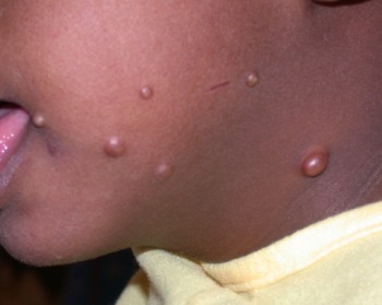 Molluscum Contagiosum Dermatology